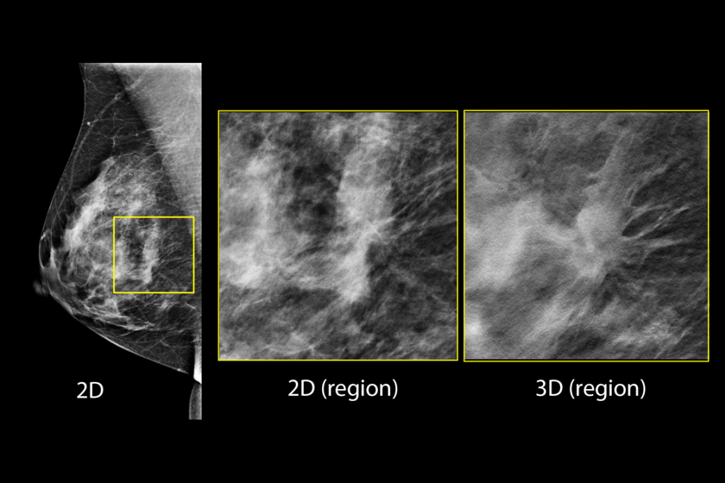 Klinische beelden van borstscan met verdachte laesie