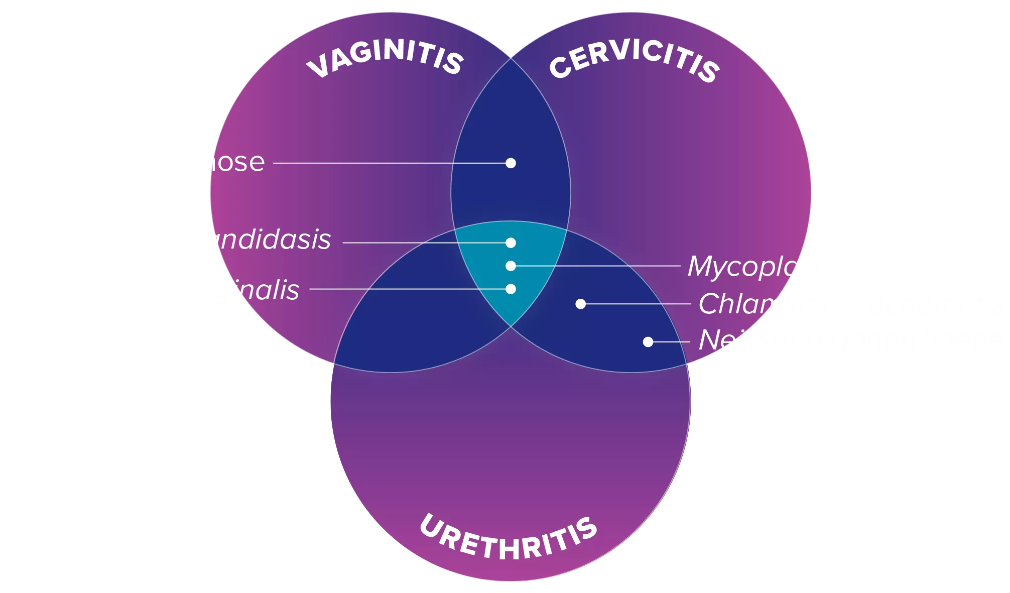 Illustratie van symptomen van Vaginitis Cervicitis Urethritis