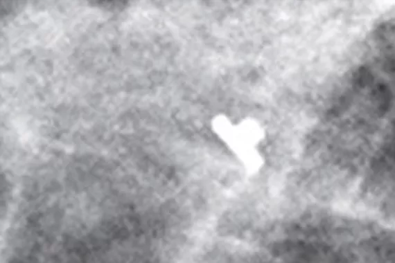 Hoge-hoedvorm op mammografisch röntgenbeeld
