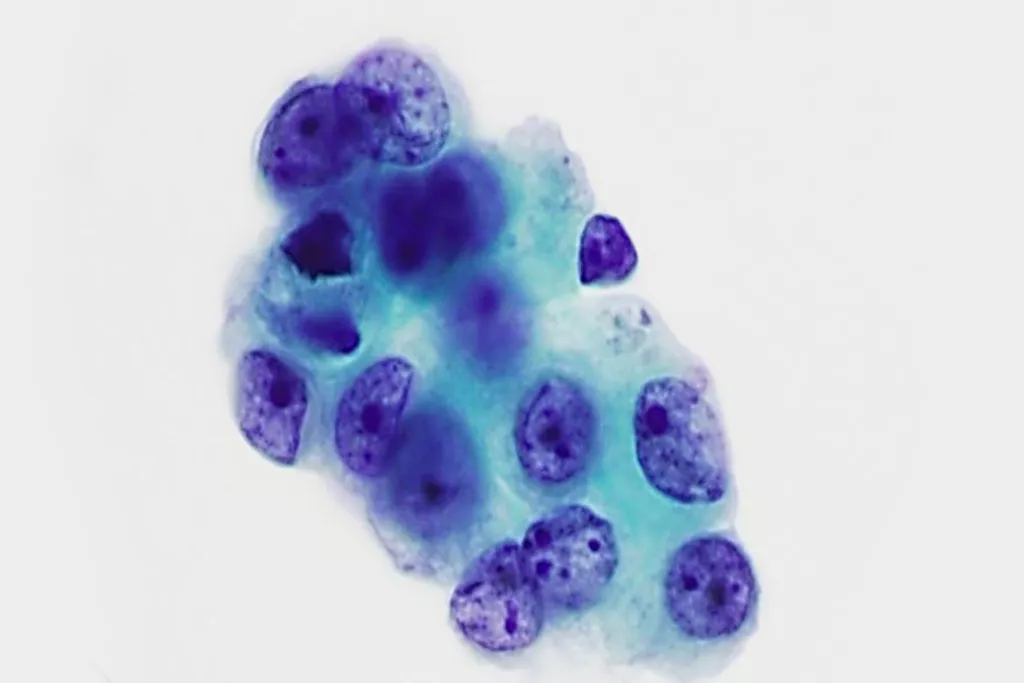 Adenocarcinoom, bronchiale spoeling, Papanicolaou-kleuring