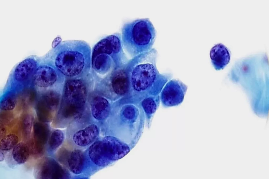 Overgangscelcarcinoom (TCC), graad 3, urine, Papanicolaou-kleuring