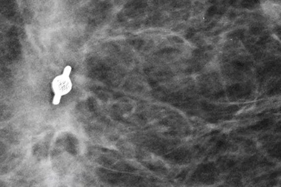 Biopsiemarkering op mammografisch röntgenbeeld