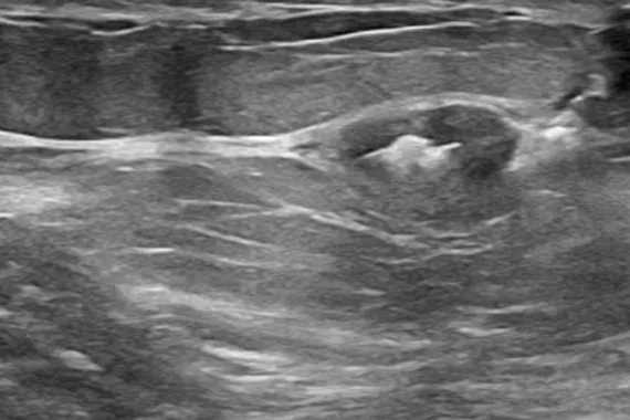 Echografisch röntgenbeeld