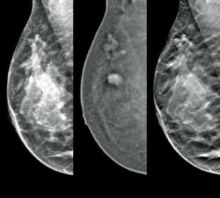 Hologic Hologic I-View™ contrastversterkte beeldvorming